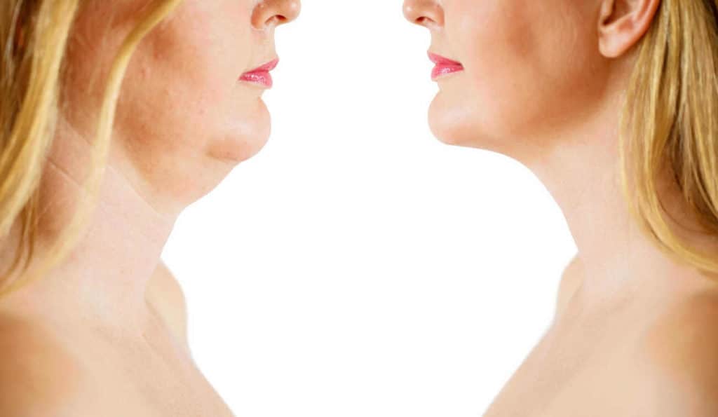 Double Chin treatment Hammersmith before and after results