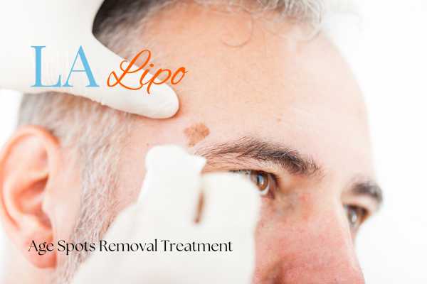 What Are the Most Effective Treatments for Age Spots Hammersmith?