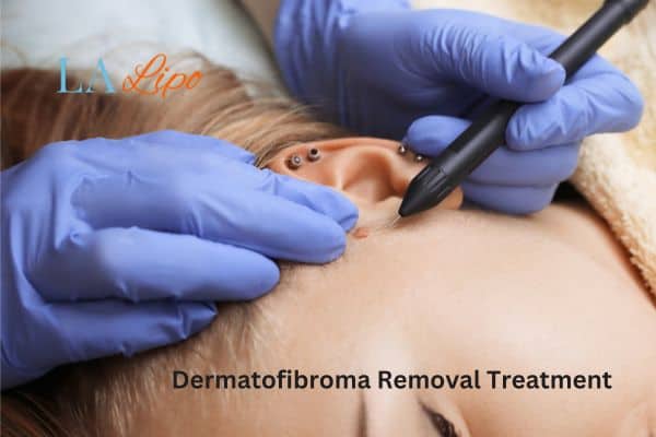 Dermatofibroma Removal Treatment Hammersmith