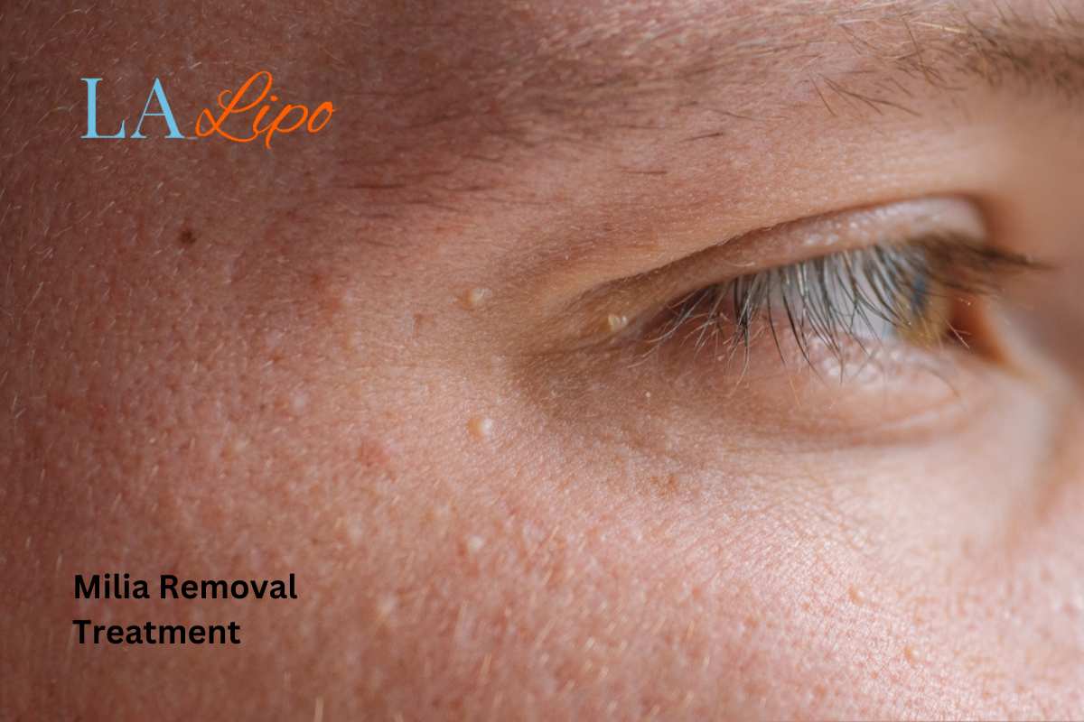 Cryopen Milia Removal: Is It the Easiest and Safest Option Hammersmith?
