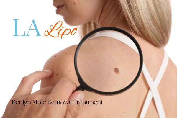 Why getting moles removed Hammersmith can boost your confidence!