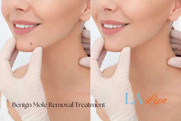 woman's before and after mole removal Hammersmith results