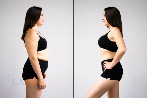 image of woman before and after results of LA-EMS Body Sculpting Hammersmith to help treat Diastasis recti