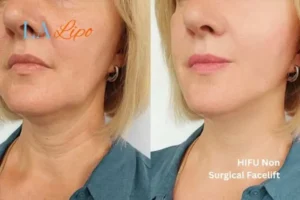 hi-fu for wrinkles Hammersmith before and after results