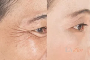 Before and after results of woman - HI-fu wrinkles reduction treatment Hammersmith