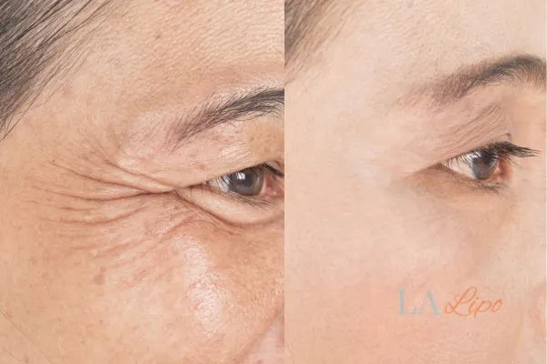 Before and after results of woman - HI-fu wrinkles reduction treatment Hammersmith