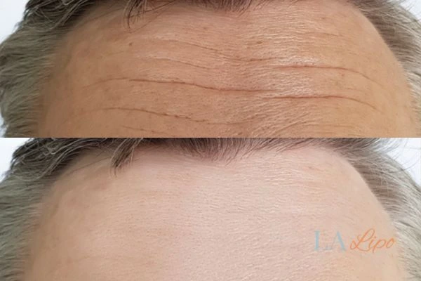 results of HIFU Hammersmith on mans forehead to help reduce lines and wrinkles