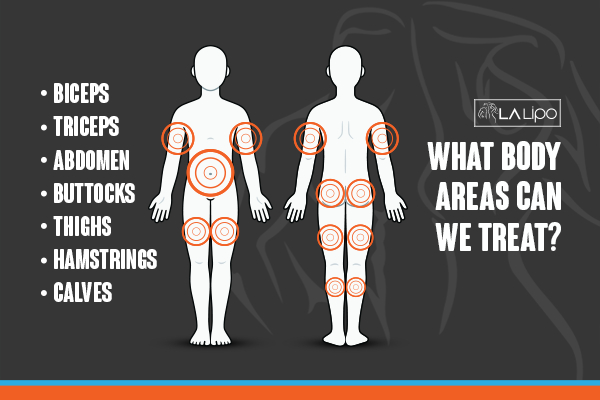 Graphic to show areas you can have LA-EMS Body Sculpting Hammersmith treatment.