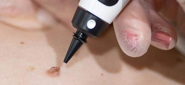 skin tag removal using cryopen Hammersmith