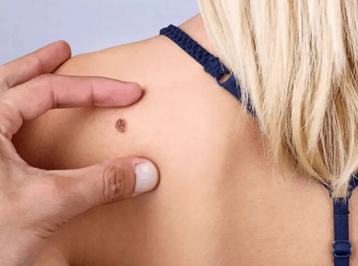 woman having mole removal Hammersmith consultation before treatment.