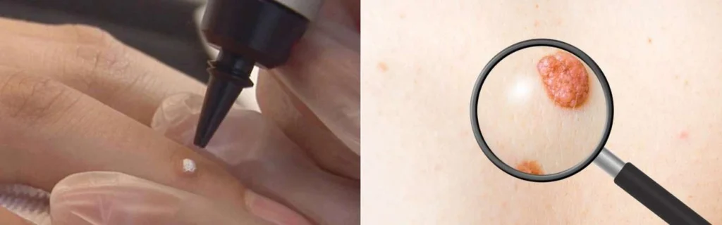 Person getting moles removed with cryopen Hammersmith