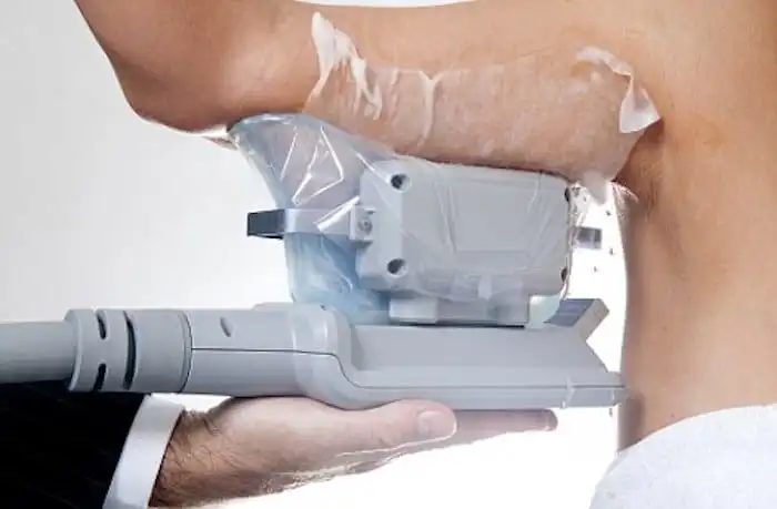 Picture of fat freezing Hammersmith on the upper arms.