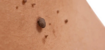 image of a skin tag Hammersmith