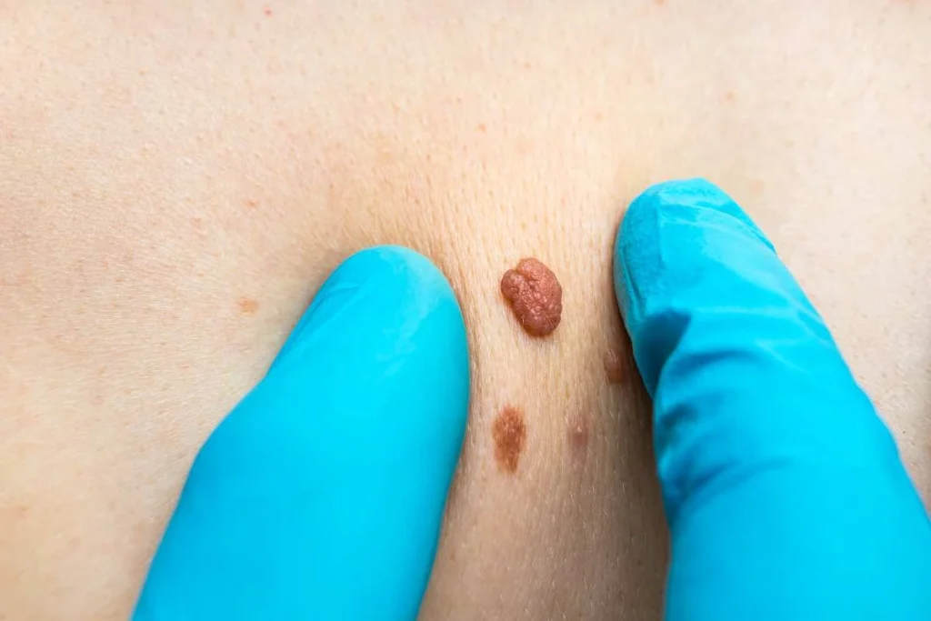 Consultant examining a skin tag Hammersmith