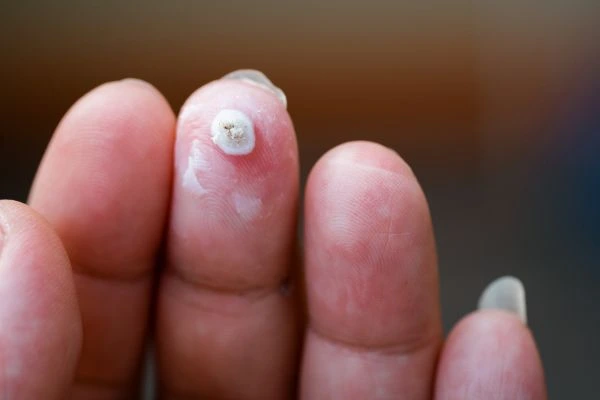 wart on person finger - cryotherapy to treat from LA LIPO Hammersmith