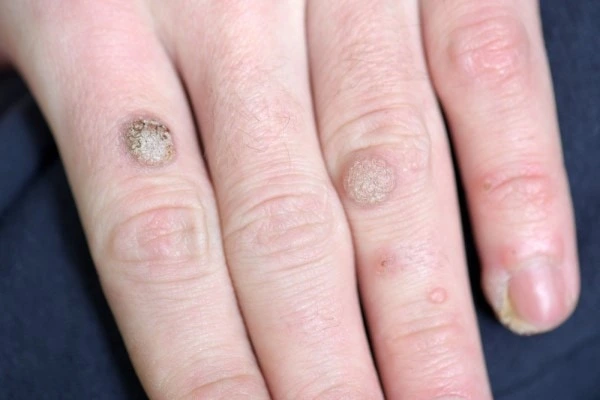 photo of warts on person hand - see wart removal Hammersmith from LA LIPO
