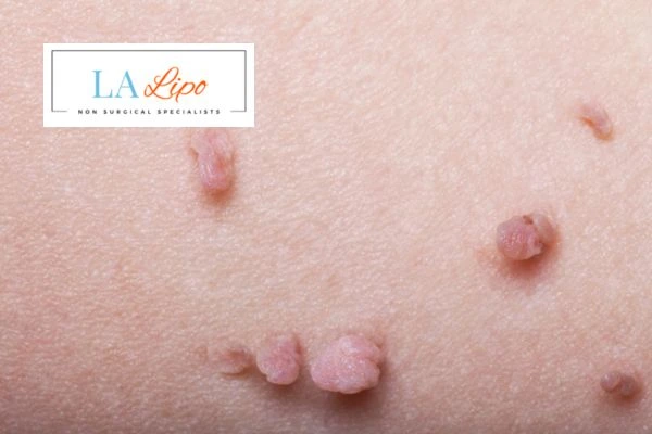 Does cryopen skin tag removal Hammersmith hurt? Find out now call our team today!