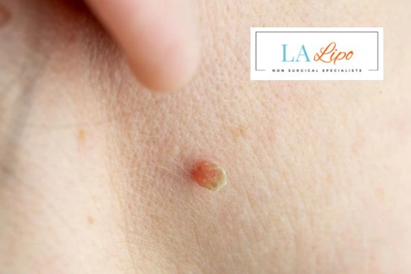 Book skin tag removal Hammersmith today speak to our team now!