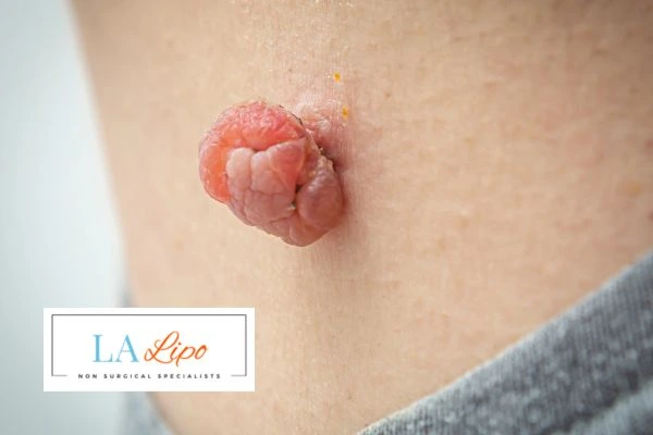 Interested in skin tag removal Hammersmith? Concerned about the pain? Find out more today!