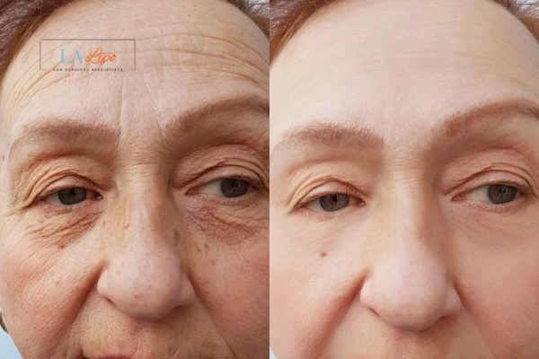 The powerful benefits of Morpheus8 Treatment Hammersmith - Call Our team today!