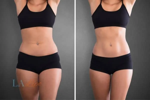 before and after results of non-surgical treatment to help a woman's body image and mental health Hammersmith