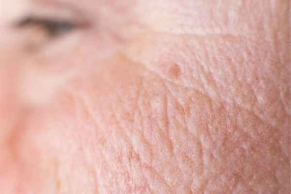close up picture of a woman's face showing an age spot Hammersmith