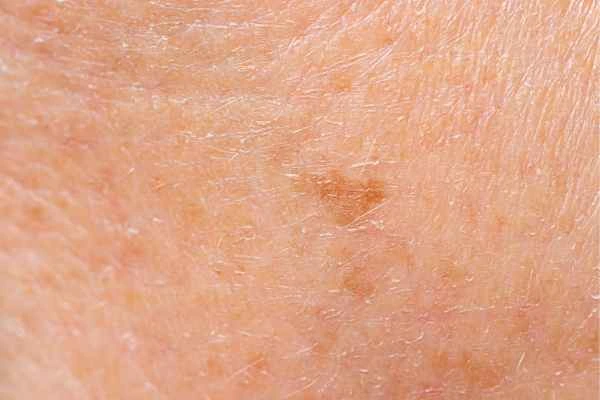 close up picture of age spots Hammersmith