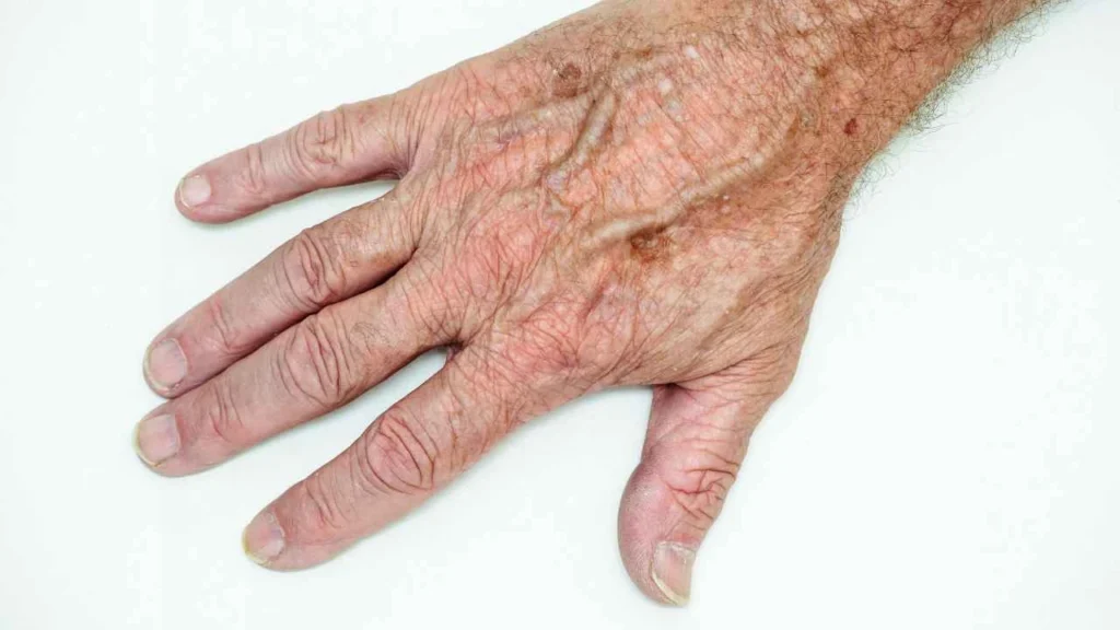 Male hand showing age spot Hammersmith
