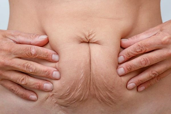 Should I Combine Diastasis Recti Treatment with Body Contouring for Better Results Hammersmith?