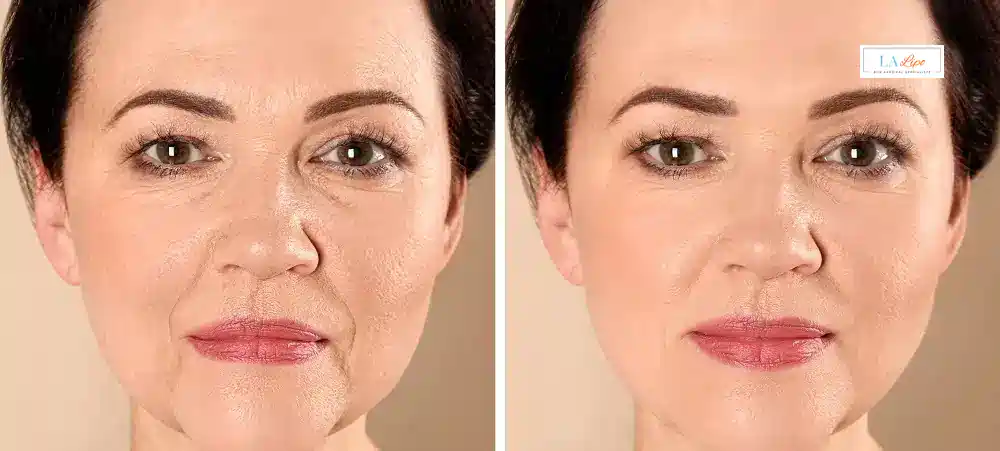 How Long Does It Take to See Results and How Long Do They Last Hammersmith?