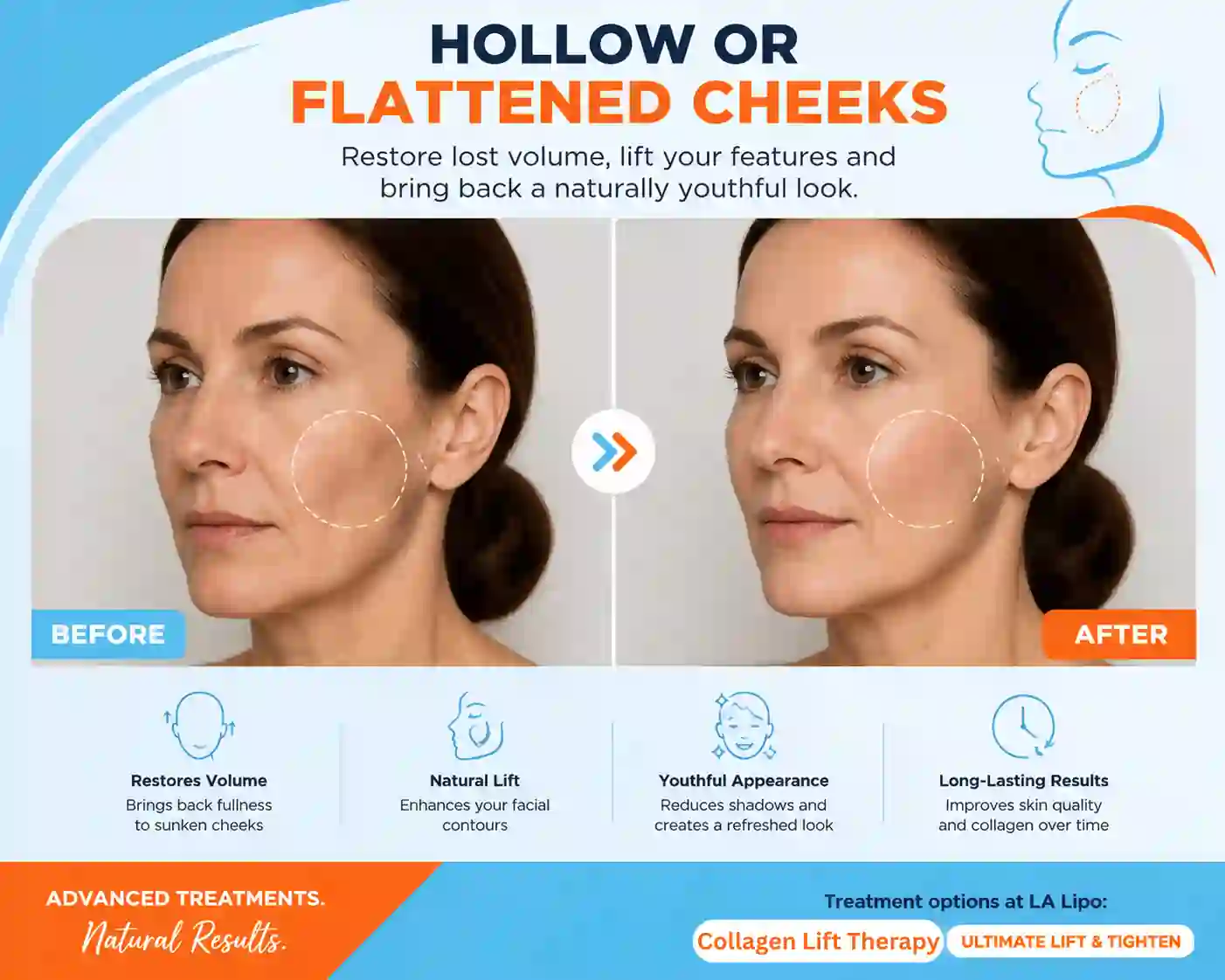 Sign #4: Hollow or Flattened Cheeks Hammersmith