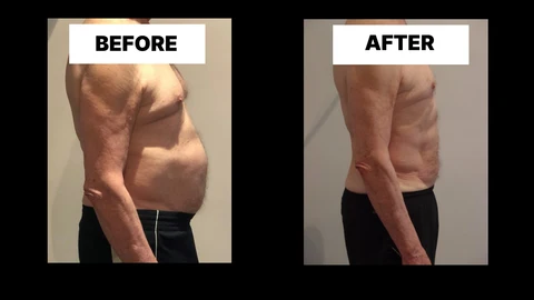 What Symptoms Can Diastasis Recti Cause in Men? Weak Core, Back Pain and Poor Posture Hammersmith